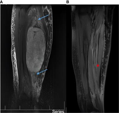 Case Report: Adjuvant image-guided radiation therapy reduces surgical invasiveness in malignant peripheral nerve sheath tumors